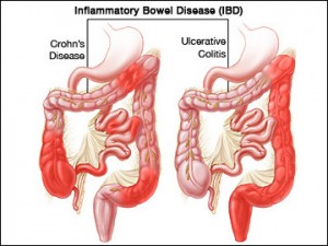 Ulcerative Colitis