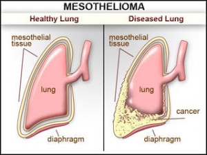 meso_lung