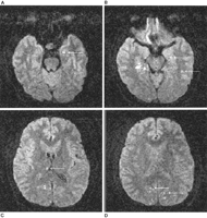 transient-global-amnesia-picture